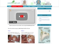 5 Easy Steps applying Bobbi Shield post circumcision surgery