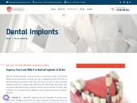 Dental Implants In Al Ain | Best Dental Implants UAE