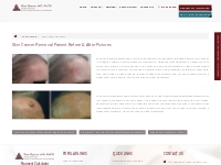 Signs of Skin Cancer Chicago, Skin Cancer Surgery Chicago, Skin Cancer