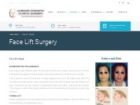 Face Lift Surgery in Chennai | Face Lifting Surgery in Chennai