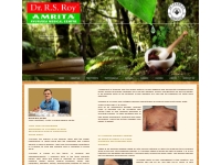 psoriasis treatment, leucoderma, vitiligo treatment in kerala, india, 