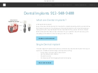  dental Implants