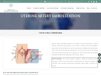  Uterine Artery Embolization in Fibroids | Fibroids Treatment and  Rec