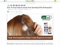 How To Stop Alopecia Areata From Spreading With Homeopathy? - Alternat
