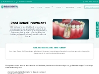 Root Canal Treatment - Risus Dental Clinic