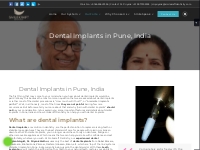 Dental implants in Pune, India | Painless| Best dental implantologist
