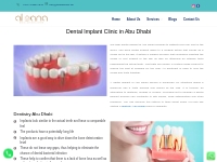 Best Dental Implant in Abu Dhabi | Best Dentistry Abu Dhabi
