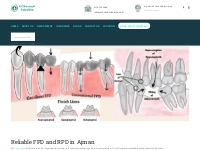 FPD And RPD In Ajman | Denture Treatment in Ajman