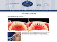 Professional Dental Cleaning Karachi|Scaling|Gum Disease Treatment  | 