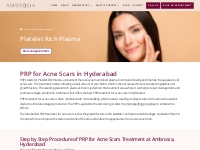 PRP for Acne Scars in Hyderabad | Ambrosia Clinic