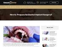 How to Prepare for Dental Implant Surgery? - Pinnacle Dental