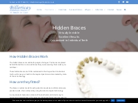 Hidden Braces - Billericay Orthodontics
