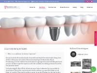 How much do dental implants cost | Dental Implant Process | Dental Imp