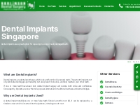 Dental Implants Full Mouth East Coast Singapore | Burlinson