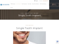 Single Tooth Implants In Sydney | Care Dentistry