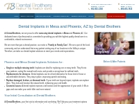 $2850 Dental Implants in Phoenix and Mesa AZ - Dental Brothers