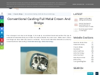 Conventional Casting Full Metal Crown And Bridge ~ Dr. Bharat Katarmal