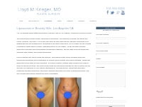 Liposuction Beverly Hills | Drlloydkrieger.com