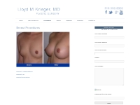 Breast Procedures in Beverly Hills Ca