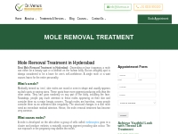 Best Laser Mole Removal Treatment in Hyderabad | Dr Venus