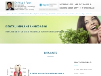 Dental Implants Ahmedabad | Dental Implant India | Implantologist Guja
