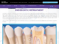 Best Endodontist Livermore | Endodontist Specialist Livermore