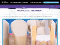 Root Canal Dentist Specialist Dublin CA | Dublin Endodontics