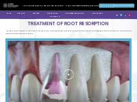 Endodontics Dental Services Pleasanton | Root Canal Specialist Pleasan
