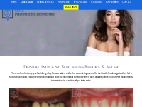 Dental Implant Before After Gallery | Washington DC