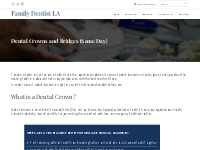 Dental Crowns and Bridges (Same Day)   Family Dentist LA