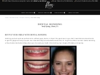 Dental Bonding | Cosmetic Dentist in Atlanta, GA