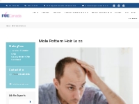 Hair Transplant Clinic | About Male Pattern Hair Loss | FUE Canada