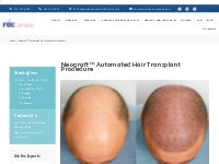Neograft™ Automated Hair Transplant Procedure - FUE Canada