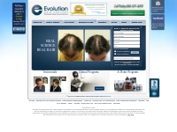 Hair Loss Treatment | Laser Hair Growth | Evolution Hair Loss Institut