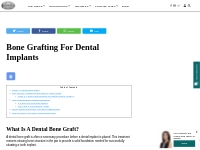 Bone Grafting For Dental Implants | iSmile Specialists