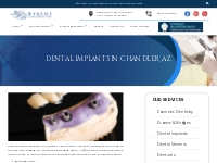 Dental Implants in Chandler, AZ | Kyrene Family Dentistry