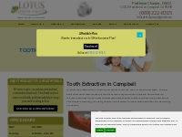 Tooth Extraction - Lotus Dental Group