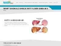 Non Alcoholic Fatty Liver Disease - Nash24x7