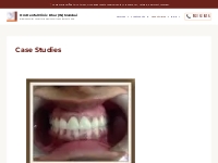 Case Studies Archives - Om Dental Clinic Khar (W) Mumbai
