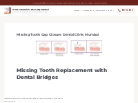 Dental Clinic Mumbai Missing Tooth | Gap Closure Dental Clinic