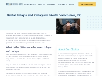 Dental Inlays and Onlays North Vancouver | Peak Dental Arts