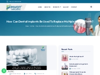 How Can Dental Implants Be Used To Replace Multiple Missing Teeth?   P