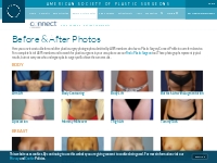     Plastic Surgery Before and After Photos | ASPS