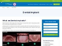 Best Dental Implants clinic | Dental Implants cost in India