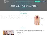 Root Canals and Extractions   Ridgeview Dental Care