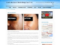Acne Scar removal | Visakha Institute of Skin And Allergy