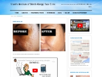 Dermaroller | Visakha Institute of Skin And Allergy