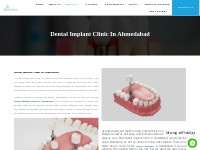 Best dental Implants clinic in Ahmadabad | Dentist in Ahmedabad