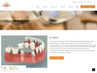 Dental Crowns Coquitlam | Dental Bridge Coquitlam