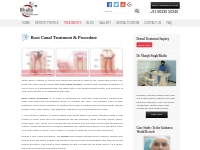 Root Canal Treatment   Procedure - Dental Implants in India